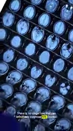 医生依赖MRI、脊髓穿刺和症状组合进行诊断